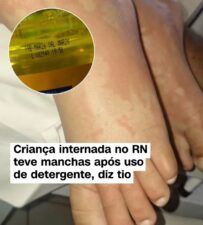 Criança internada em Natal após suspeita de intoxicação por detergente passa oito dias em tratamento 1 WhatsApp Image 2026 05 15 at 09.45.02 Criança internada em Natal após suspeita de intoxicação por detergente passa oito dias em tratamento